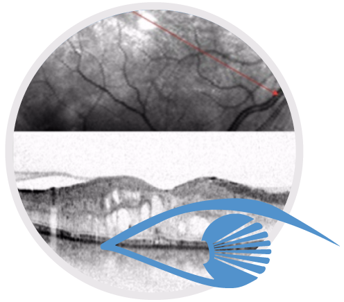 Maculopatia
