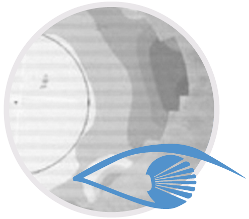Topografia Corneale